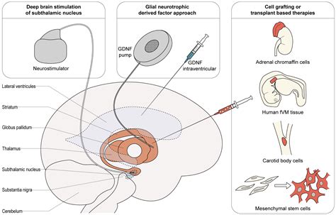 Ijms Free Full Text Neuroprotective Surgical Strategies In