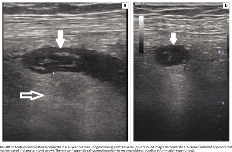 Ultrasound Of Appendicitis