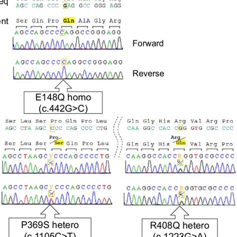 Figure4 Results Of A MEFV Gene Analysis In The Present Case E148Q