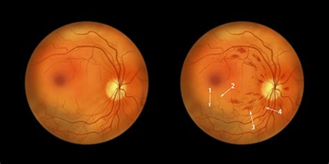 Retinopatia diabética