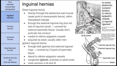 Bowel Hernias Youtube