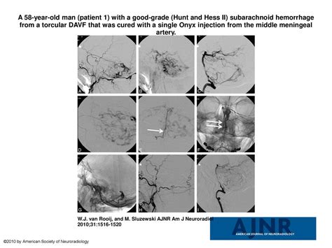 A Year Old Man Patient With A Good Grade Hunt And Hess Ii