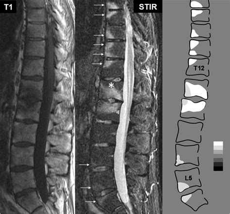 Lumbar Spine Mri Interpretation