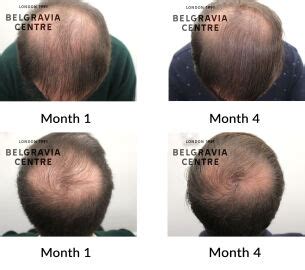 Hair Loss Success Story Very Pleased With Results