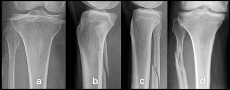 Fibular Avulsion Fracture