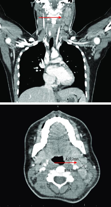 Abdominal CT Scan Lymph Nodes