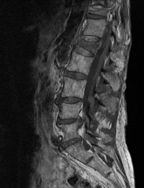 Vertebral Body Fracture Classification