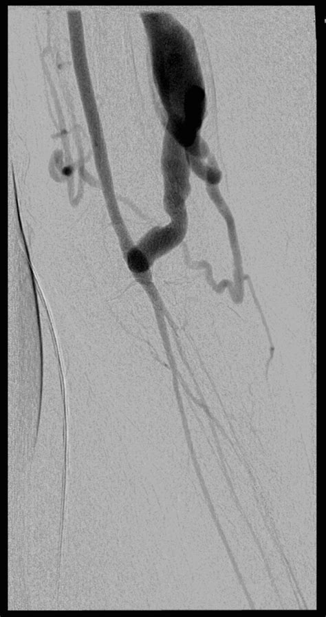 Distal Revascularisation With Interval Ligation Dril An Experience