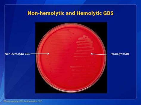 GBS Lab Photo Examples Group B Strep CDC