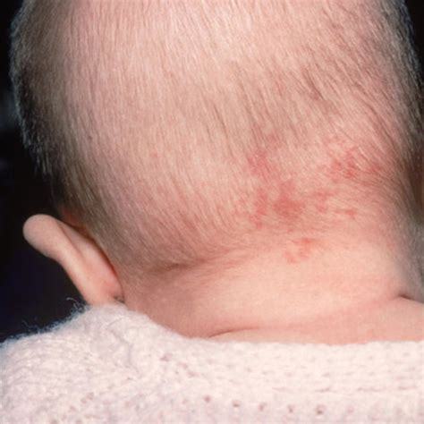 Baby Skin Issues And Conditions What To Expect