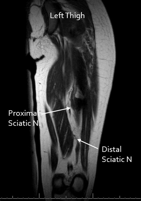 Lateral Femoral Cutaneous Nerve Mri