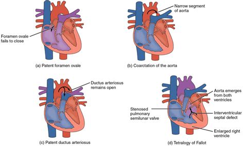 Congenital Heart Disease In Adults 3 Complex Defects Online Learning