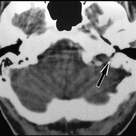 Axial T1-weighted MRI, showing the right jugular foramen (arrow head ...