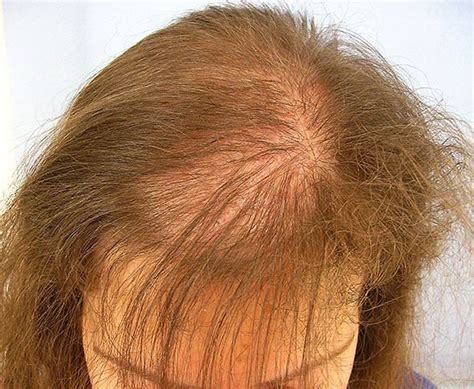 Women hair loss treatment in Lahore | Free checkup & consultation call us