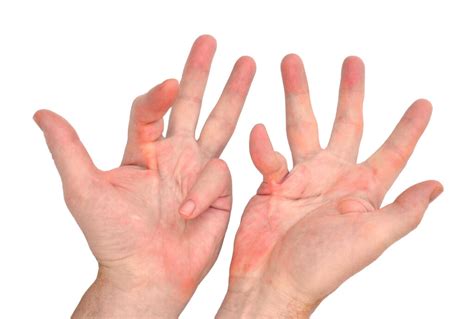 Dupuytren S Contracture Exercises Hand Therapy Academy