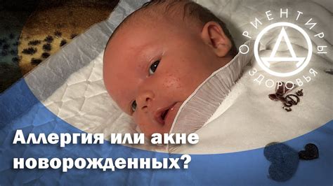 Аллергия или акне новорожденных? - YouTube
