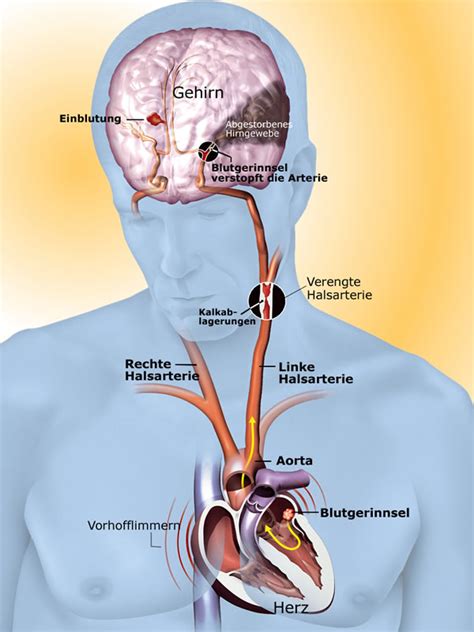 Schlaganfall Ursachen Wie Kommt Es Zum Schlaganfall Apotheken Umschau