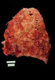 Cystic Fibrosis Mucoviscidosis Congenital Polycystic Lung Diagnosis