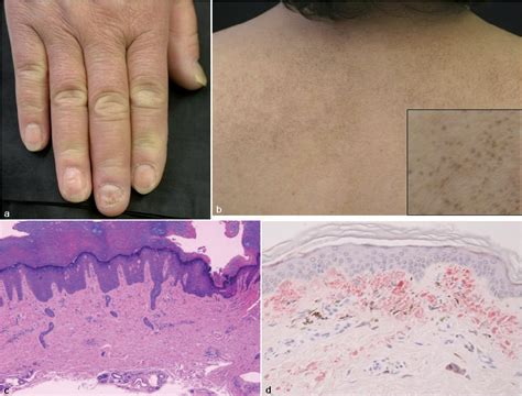 Primary Localized Cutaneous Amyloidosis In Patients With Scleroderma