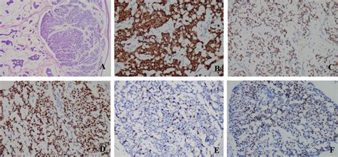 A Pathological Slice Of The Nodule Revealed Pools Of Extracellular