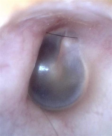 Normal Tympanic Membrane