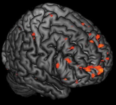 Brain Activation Abnormalities IMAGE EurekAlert Science News Releases