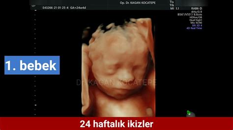 24 Haftalık Ikiz Gebelikte Bebeklerin Her Birinin 4 Boyutlu Ultrason Görüntüleri Dr Kağan