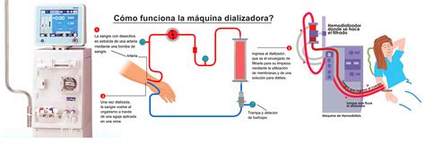 La Hemodialisis