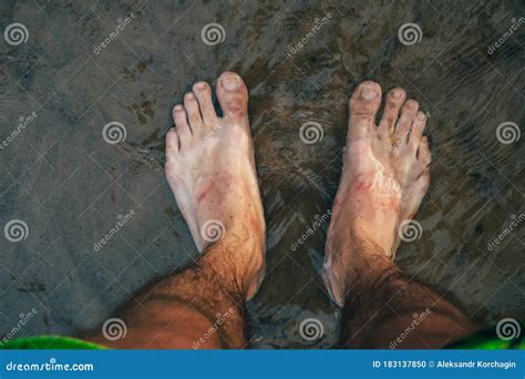 Blisters On The Feet Stock Photo 146356980