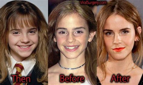 Emma Watson Plastic Surgery Before And After Nose Job Pictures Nose