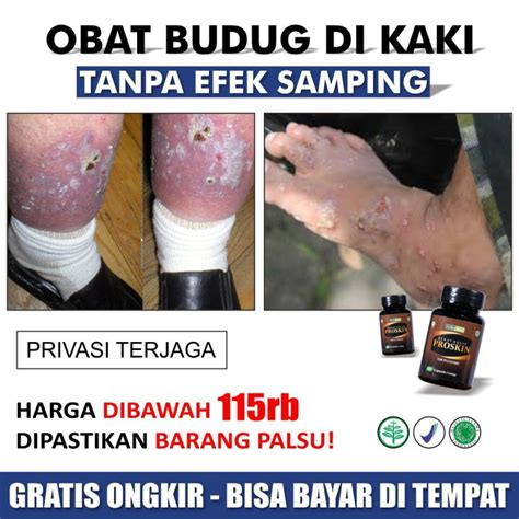 Penghilang Budug Di Kaki Obat Kulit Gatal Borok Bernanah Cenang Gatel