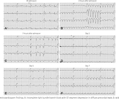 Figure 1 From A Case Of Reversible Very Low Voltage Electrocardiogram