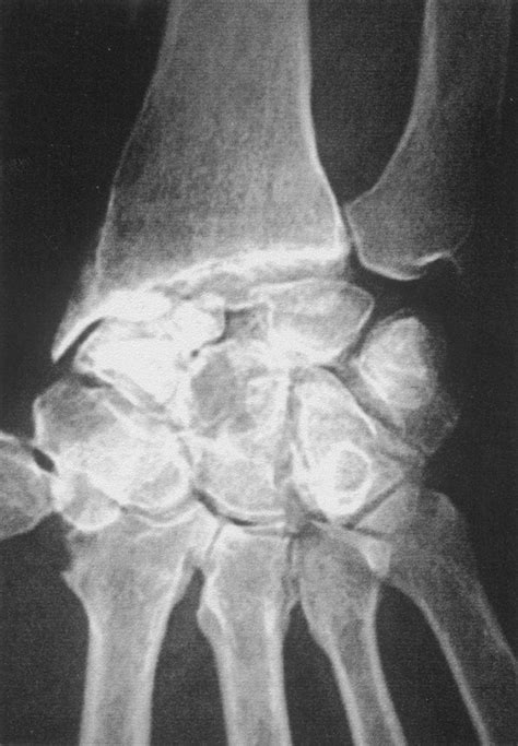 Les fractures occultes du scaphoïde carpien Détection par la