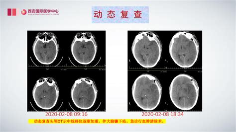 开颅颅咽管瘤术后并发左侧颈动脉闭塞1例 脑医汇 神外资讯 神介资讯