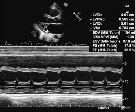 Transthoracic 2D Echocardiography At Admission Showed Severe Reduced