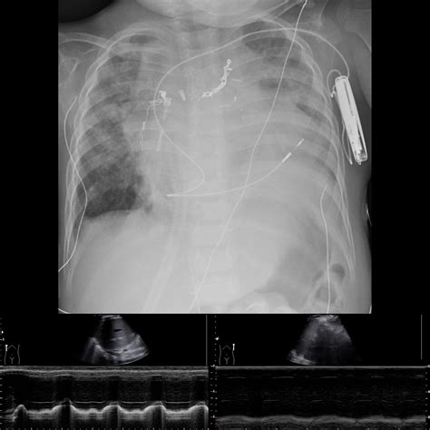 phrenic nerve palsy | pacs