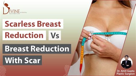 Scarless Breast Reduction Vs Breast Reduction With Scar YouTube