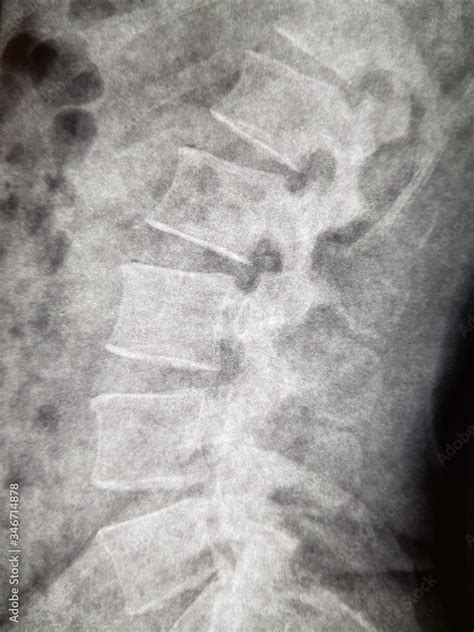 X-ray of the human spine Stock Photo | Adobe Stock