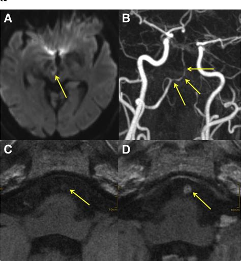 Neurosyphilis Mri