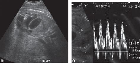 Figure From Repeated Paracentesis In A Fetus With Meconium