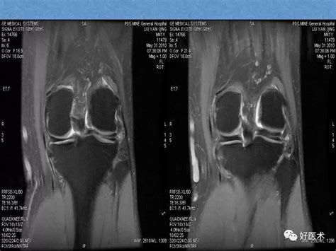 膝关节mri高清解剖及疾病诊断图解，此课件推荐收藏！ Medsci Cn