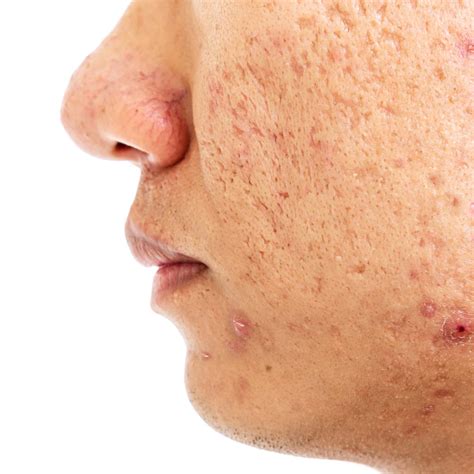 Understanding and Treating Acne Scars: A Guide to Smoother Skin – Acne ...