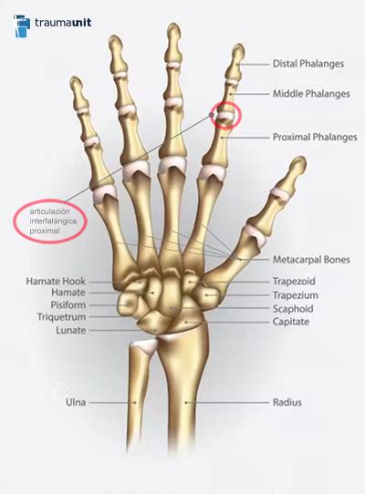 Cirug A De Dedo Pr Tesis De La Articulaci N Interfal Ngica Proximal