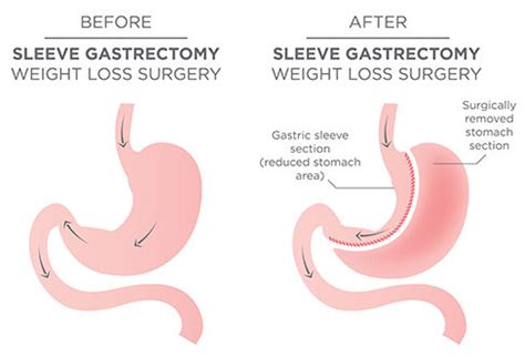 Sleeve Gastrectomy - Johns Creek, Alpharetta, Roswell, Atlanta | Johns Creek Surgery