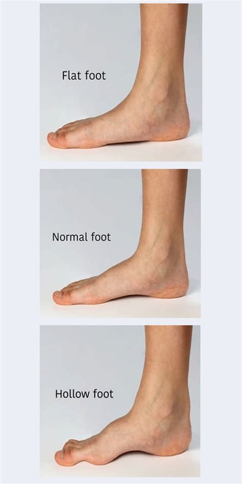 High Arch Feet Cavus Foot Diagnosis And Treatment