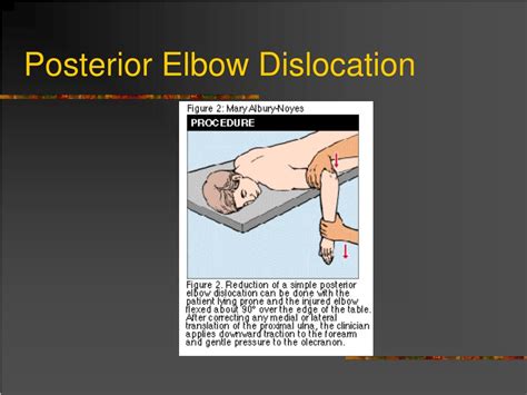 Ppt Dislocation And Fracture Reductions Powerpoint Presentation Free