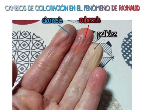 Tips Para Manejar Los S Ntomas Del S Ndrome De Raynaud Zero