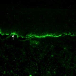 Indirect Immuno Fluorescence Of M Nacl Split Foreskin Showing Igg