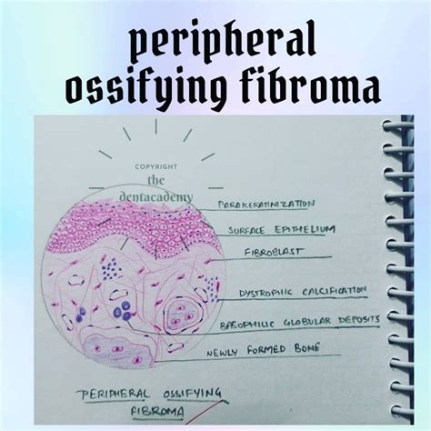 Peripheral ossifying fibroma | Dentistry, Dentist, Book cover