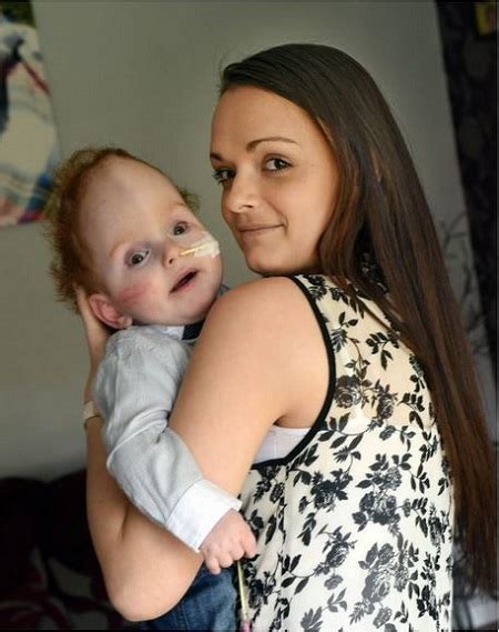 Touching Story of a Baby Boy Born With No Brain (Photos)